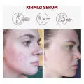 NEDOX Cilt Yenileyici Cilt Tonu Eşitleyici Kırmızı Peeling Serum 30 ml