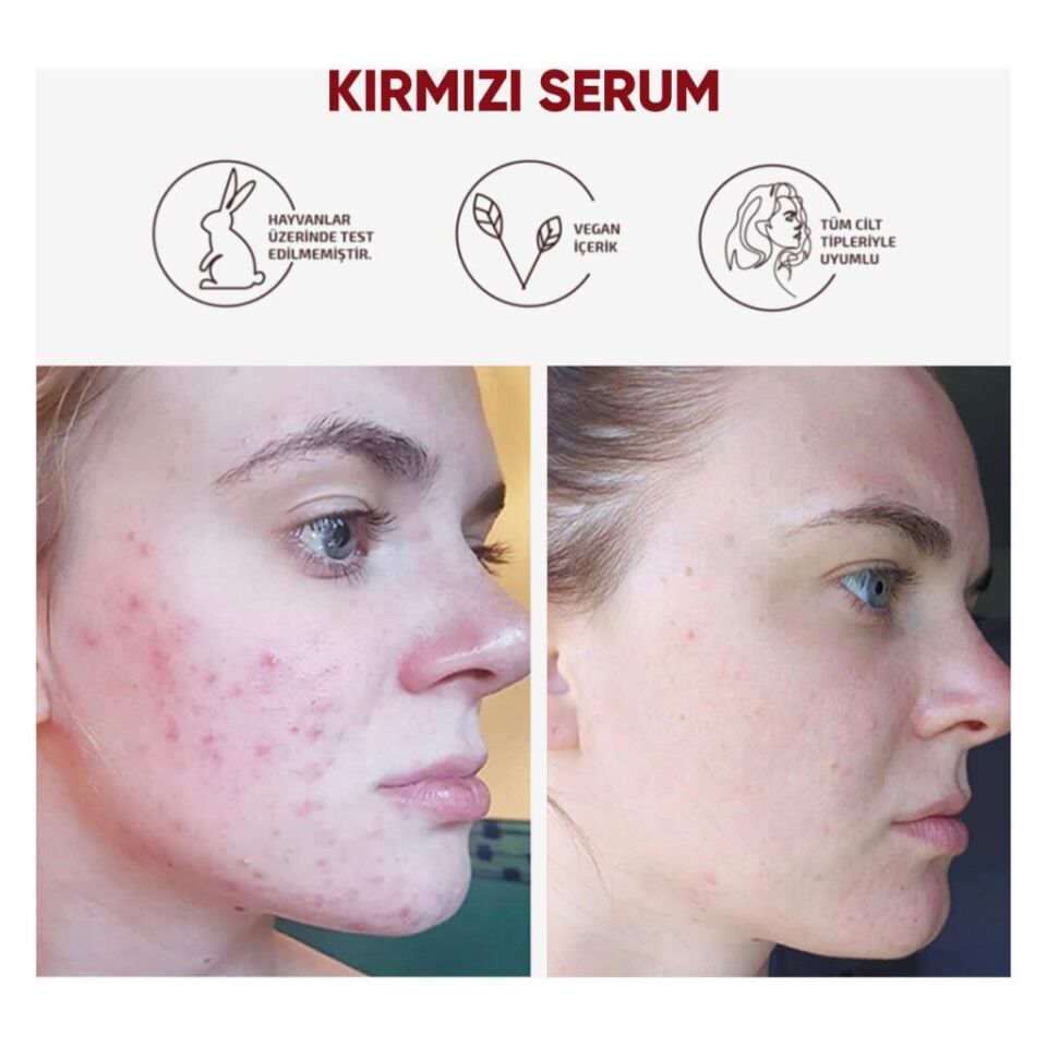 NEDOX Cilt Yenileyici Cilt Tonu Eşitleyici Kırmızı Peeling Serum Aha %30 Bha %2 Ph % 3.5 Serum 30 ml